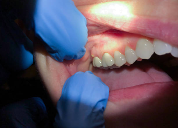 Best Lost Filling or Crown Replacement in Escanaba, MI